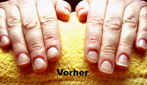 Vorher-Bild von Nägeln an denen bei Nervosität gekaut wurde